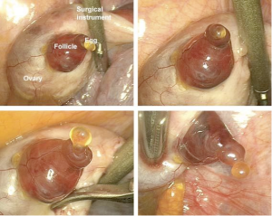 ovulation pain ligation tubal so syndrome