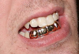 Dental grills from flickr image by jyan