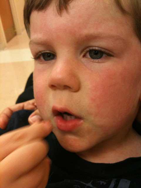 roseola-2