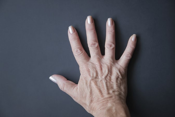 Can Low Salt Intake Improve Bulging Veins on Your Hands?