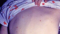 the back of a person with chickenpox