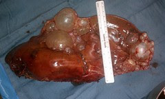 All About Hepatic Liver Cysts - Causes, Cautions And Cures.