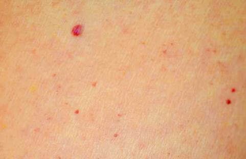 Huden på røde runde pletter Kønsrelateret Psoriasis: