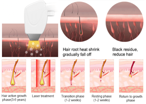 1200W Diode Laser Hair Removal Machine Introduction-BESTVIEW-Professional Medical Laser Beauty Equipment Manufacturer