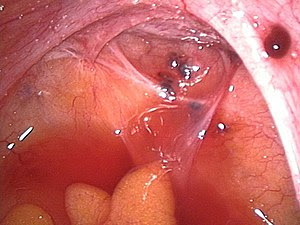 endometriotic lesions in the Douglas pouch and...