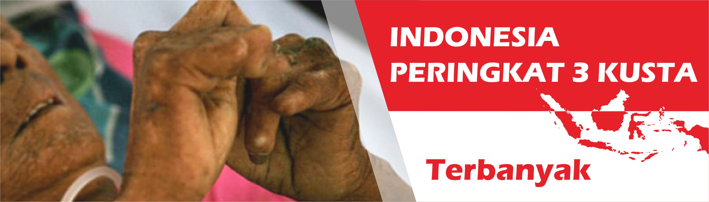 Indonesia Peringkat ke 3 Kusta Terbanyak Rumah Sakit Indonesia Peringkat ke 3 Kusta Terbanyak Rumah Sakit