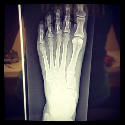 That friends is my very not broken foot!!!! So relieved. It's just a bone bruise.