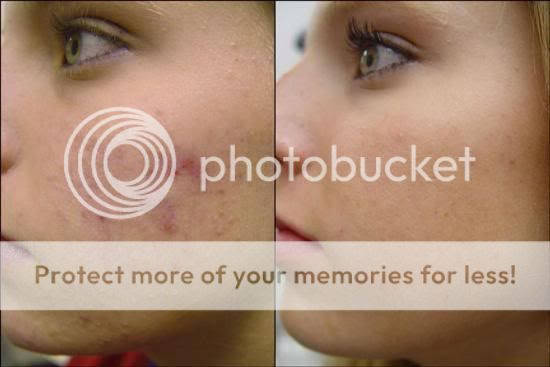acne Pictures, Images and Photos