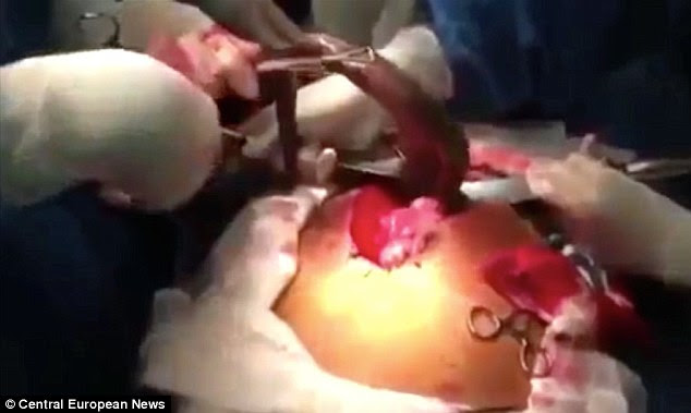 A man was forced to have surgery to have a live South American lungfish removed from his intestines