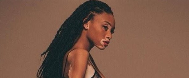 Resultado de imagem para vitiligo fotos inicio doença