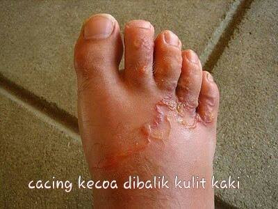 kaki akibat kecoa