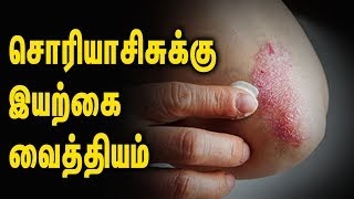 Psoriasis skin disease in tamil