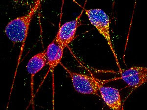 Neurônios afetados pela doença de Alzheimer apresentam diferenças sutis com os saudáveis, mas suficientes para causar uma doença que afeta a capacidade de memória e aprendizado. (Foto: Faculdade de Medicina de San Diego / Universidade da Califórnia / Nature / Divulgação)