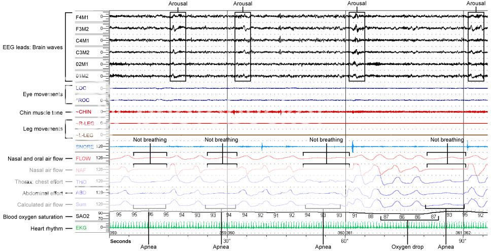 The Chronicles Of Ellie Bellie Bear: Polysomnography, Sleep Study ...