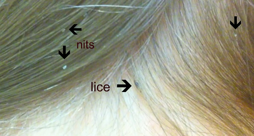 can lice go under sheers to mattresses