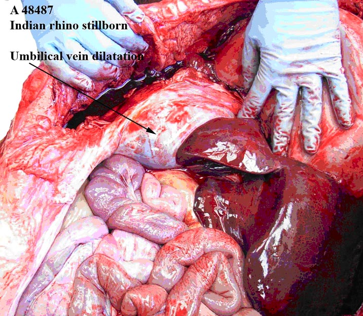 The remarkably distended portion of the umbilical vein is shown at the arrow