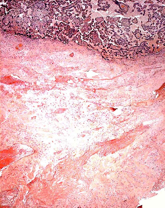The floor of the stillborn’s placenta