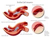  All to know about sickle cell disease