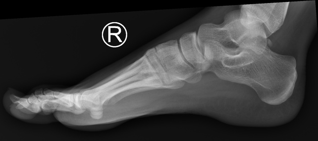 Radiografias normais do pé direito em visões AP ou dorsoplantar (à esquerda), oblíqua medial (centro) e lateral (à direita). Fonte: Radiopaedia. Dixon, A. Normal foot x-rays. Case study,