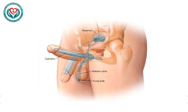 cắt bao quy đầu bị cương dương có sao không