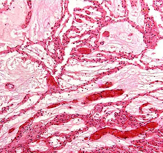 The villi of this mature placenta are edematous-appearing