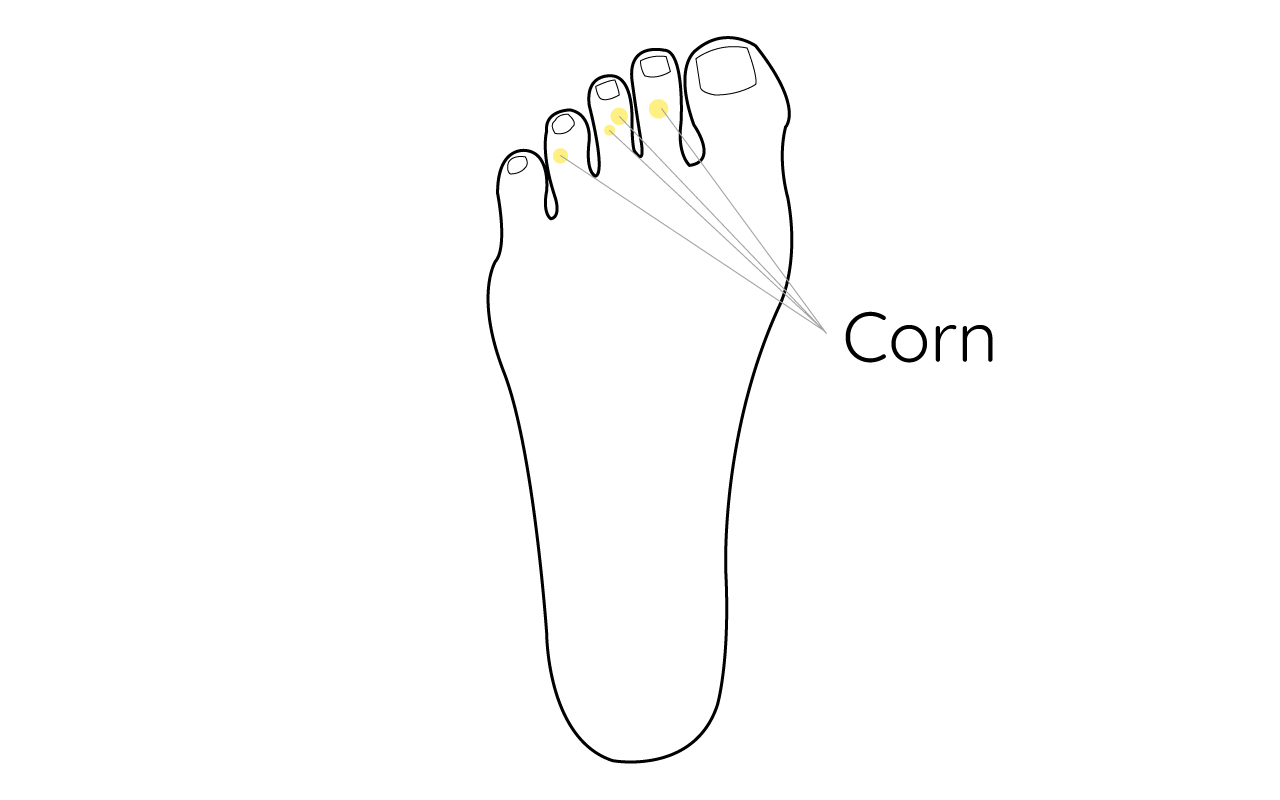 diagram of foot corn