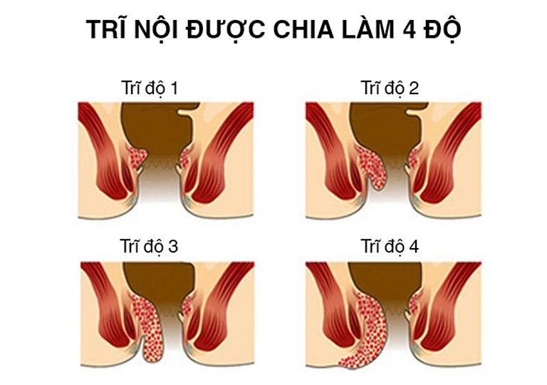 cách chữa trĩ nội độ 1 tại nhà