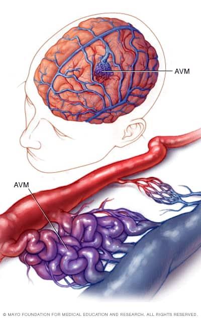 Image showing normal and abnormal blood vessels