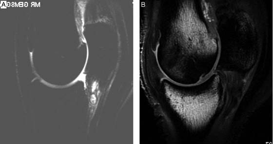 (A) MRI of tearing of the oblique distal sesamoidean ligament (STIR sequence). (B) MRI of bone edema and sclerosis with defect in distal metacarpus (T1-weighted spin echo sequence). Both images are from racehorses. 