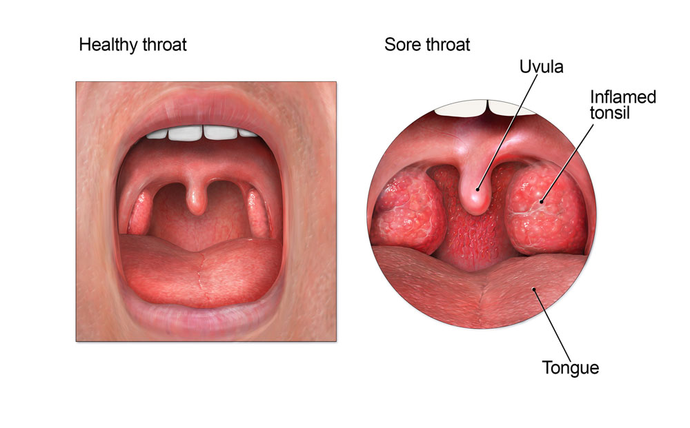 sore-throat-lg.jpg