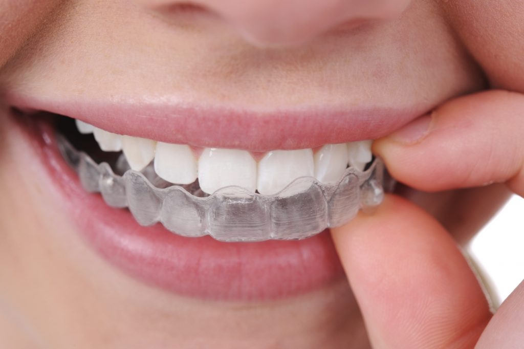 6 คลีนิกจัดฟันแบบใส คุณภาพยอดเยี่ยม ที่น่าใช้บริการในปี 2022! 2