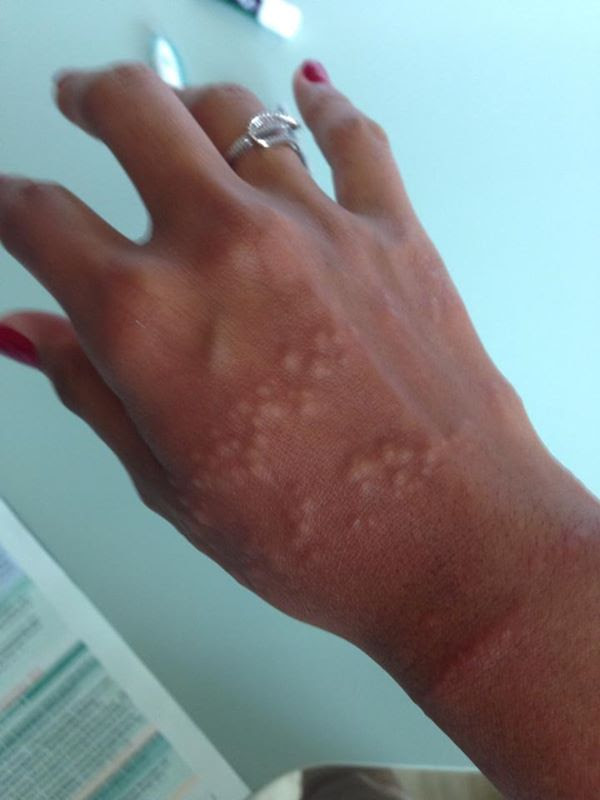 Help please! Got stung twice yesterday at Kitesurf beach and the itch is killing me! Any advice please? Thanks heaps!