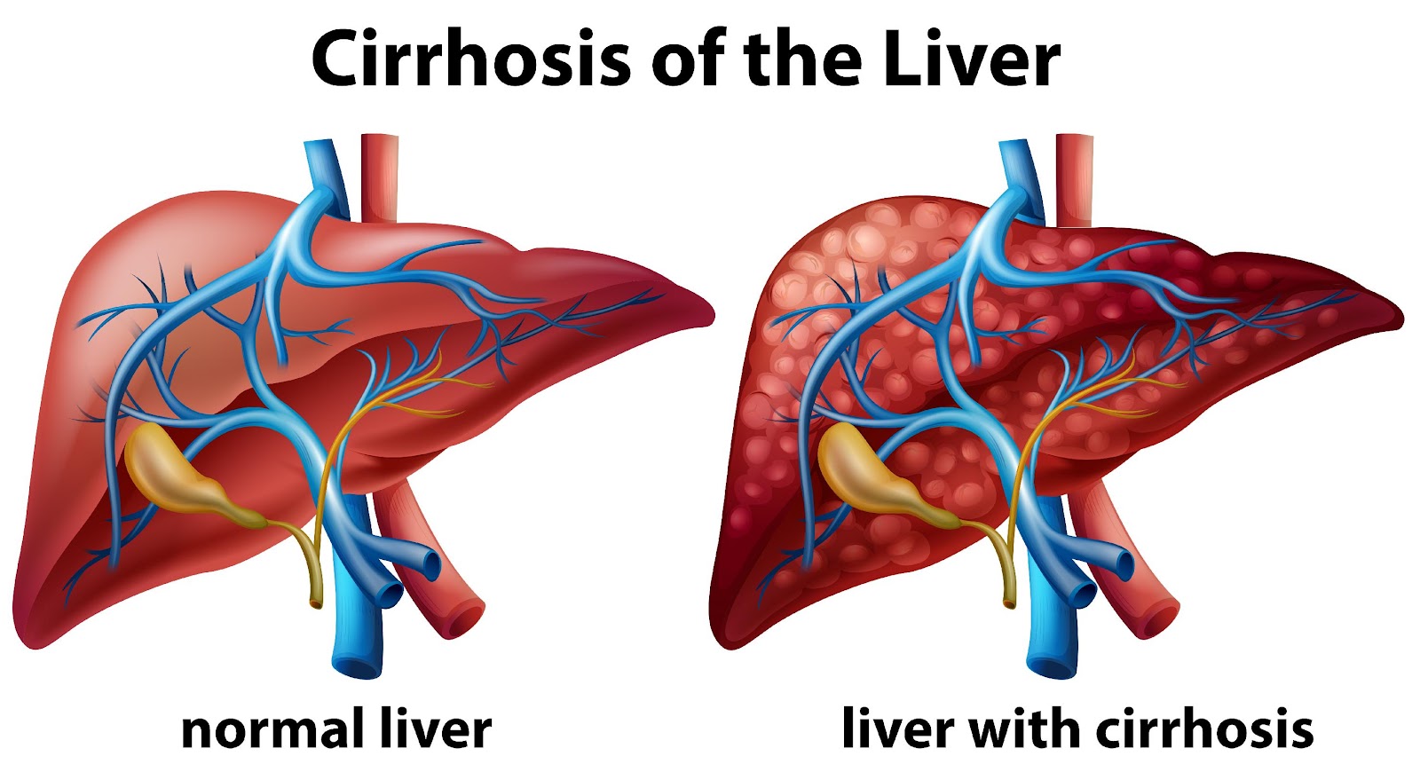 Detailed Guide on Liver Cirrhosis | Narayana Health
