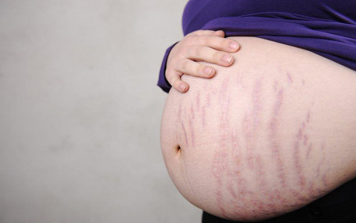 Khi mang thai, trong lượng cơ thể thay đổi đột ngột nên hình thành các vết rạn ở đùi, ngực và nhiều nhất là ở phần bụng.