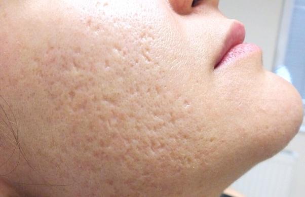 What's good for reducing large pores? - Quora