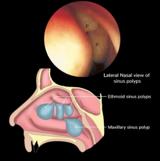 Nasal polyposis diagnosis