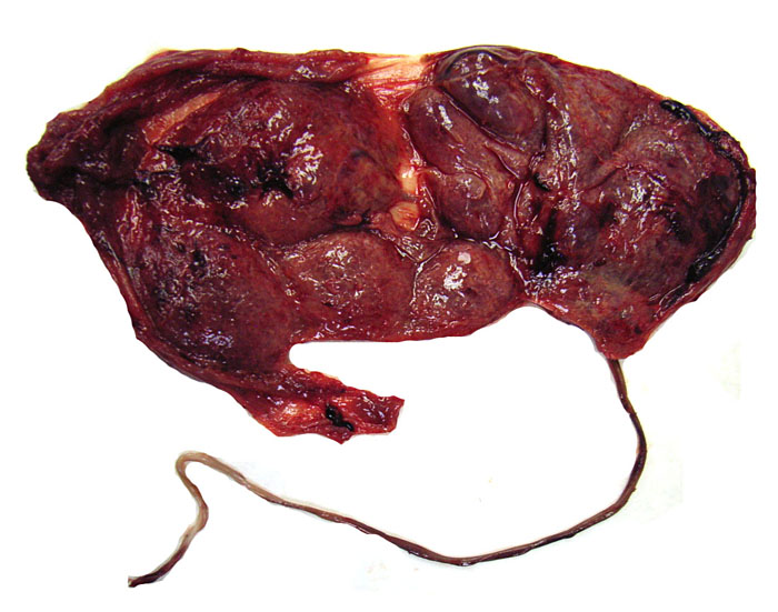 Maternal surface of the placenta. Its nearly bilobed nature is evident from the central portion of membranes