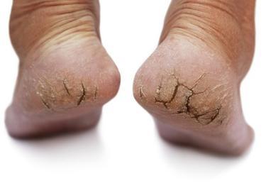 DRY CRACKED HEELS | Foot Medical Centre | Aurora Foot Specialist | Aurora  Podiatrist