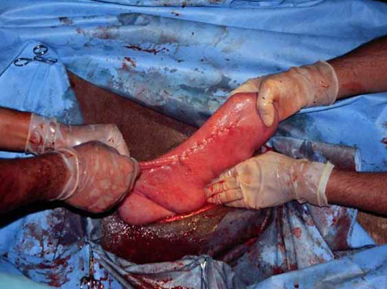 Cesarean section in the camel: Uterine closure using the Utrecht suture pattern.