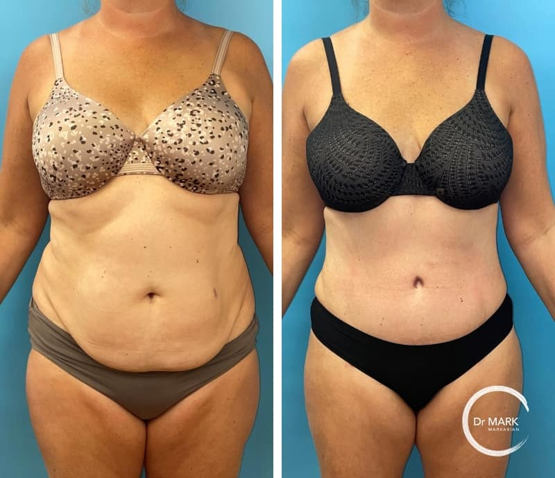 4 Tummy Tuck Before & After Photos That Prove It's Worth It - Dr. Markarian