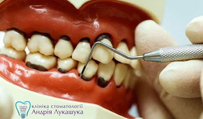 Діагностика пародонтозу | Фото 3 - Клініка Лукашука
