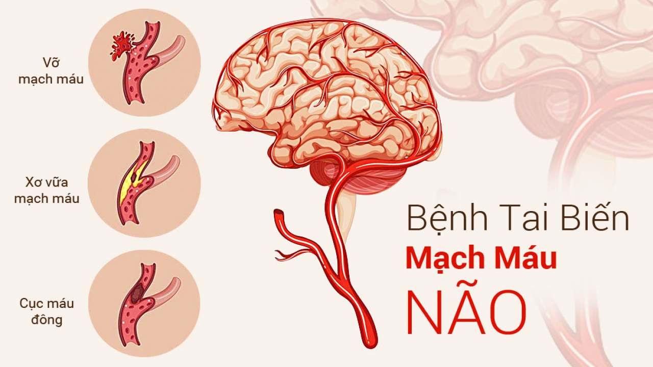 nguyên nhân tai biến mạch máu não