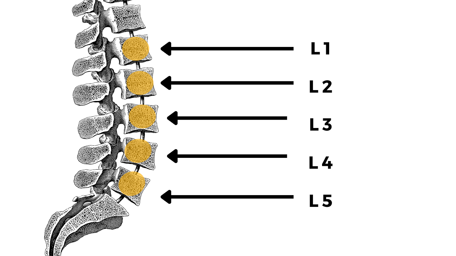 Lumbar-L4-L5-disc-herniation