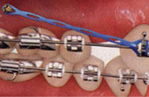 Teeth with traditional metal braces and temporary anchorage device - TADs Teeth with traditional metal braces and temporary anchorage device - TADs