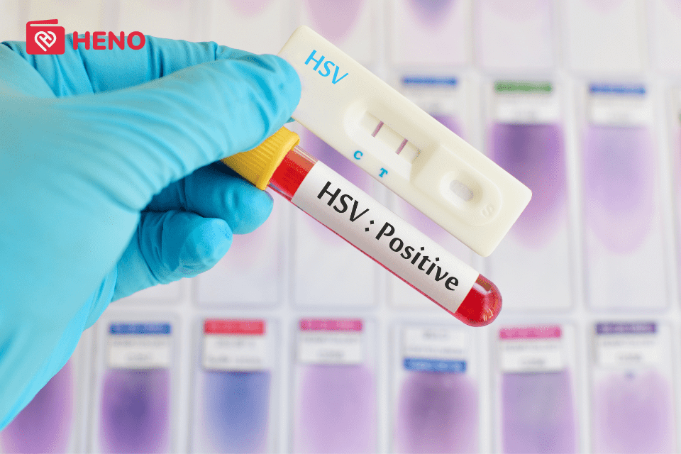xét nghiệm kiểm tra HSV gây Herpes sinh dục