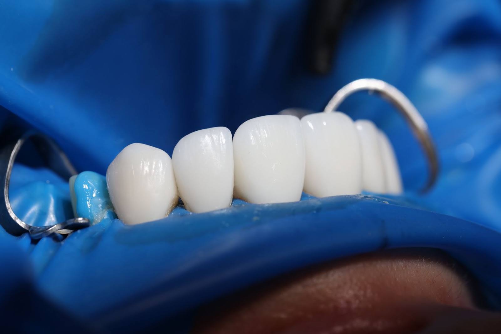 Implantes dentales en Albania
