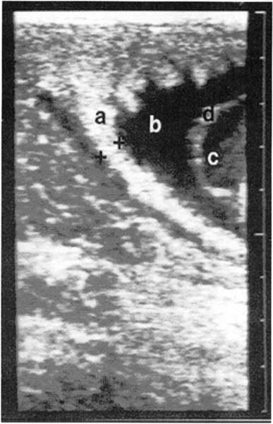Ultrasonographic image of the combined thickness of the uterus and placenta.