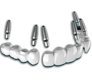 3 on 6 dental implants