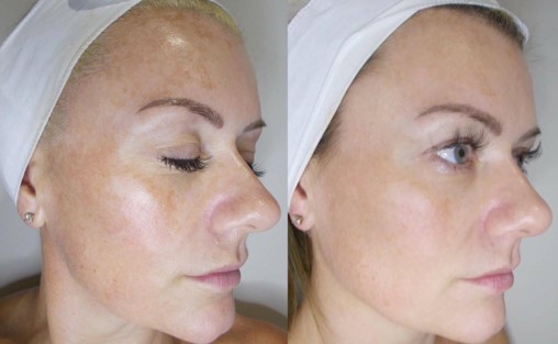 Hyperpigmentation 101: A 3-Step Expert Guide to Prevention & Treatment - beautiful jobs
