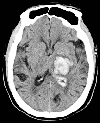 manifestações tomográficas da hemorragia intraparenquimatosa